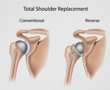 Reverse_Shoulder_Replacement-1